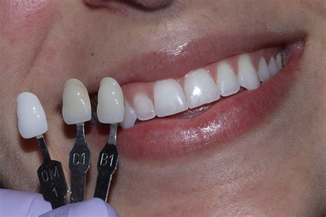 cirillas|dental veneers for teeth.